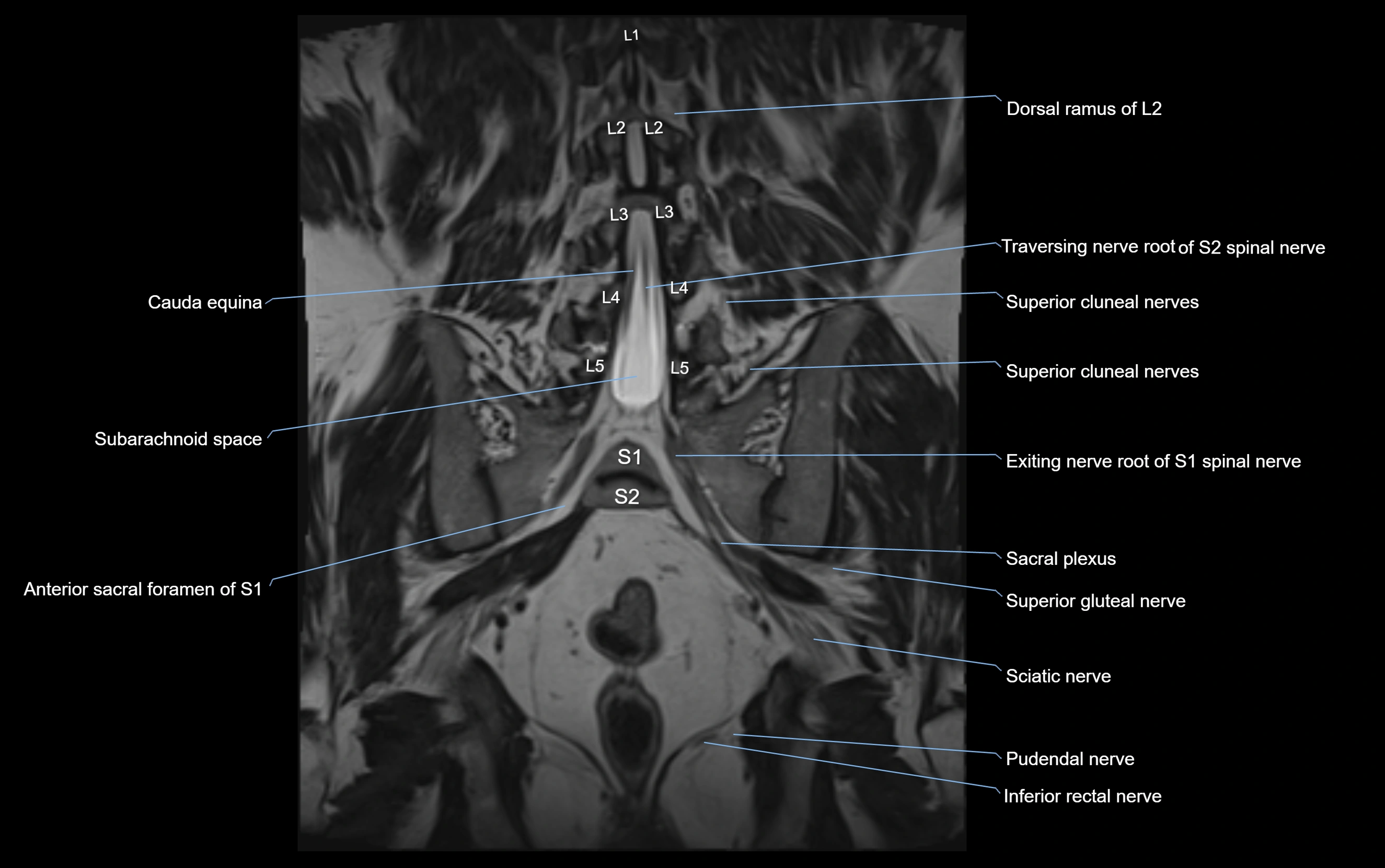 MR lumbosacral plexus cross sectional anatomy 3T  radiology  image-img-09001-00048.webp